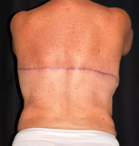 Body Lift / Upper Back Lift Before & After - Le Spa Plastic Surgery